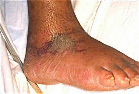 Vibrio vulnificus-Infektion Vibrio vulnificus-Infektion