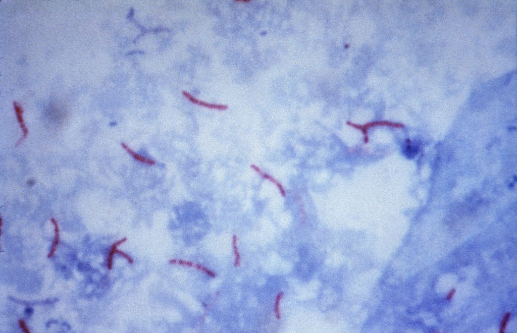 Mycobacterium tuberculosis Ziehl-Neelsen-Färbung 02.jpg