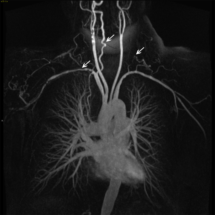 https://www.msdmanuals.com/-/media/manual/professional/images/19a-images-of-aorta-in-takayasu-arteritis-ctisus.jpg?thn=0&sc_lang=de