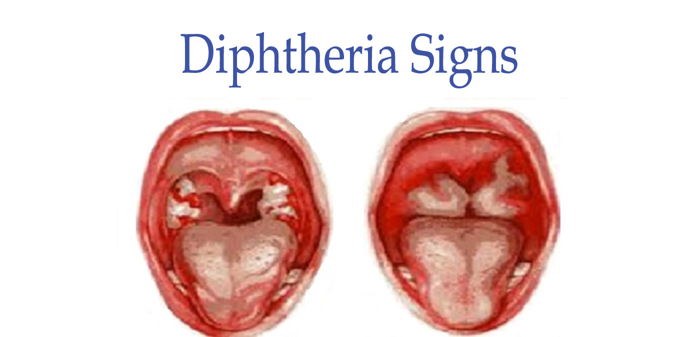 Diphtherie: Ursachen, Symptome und Behandlung