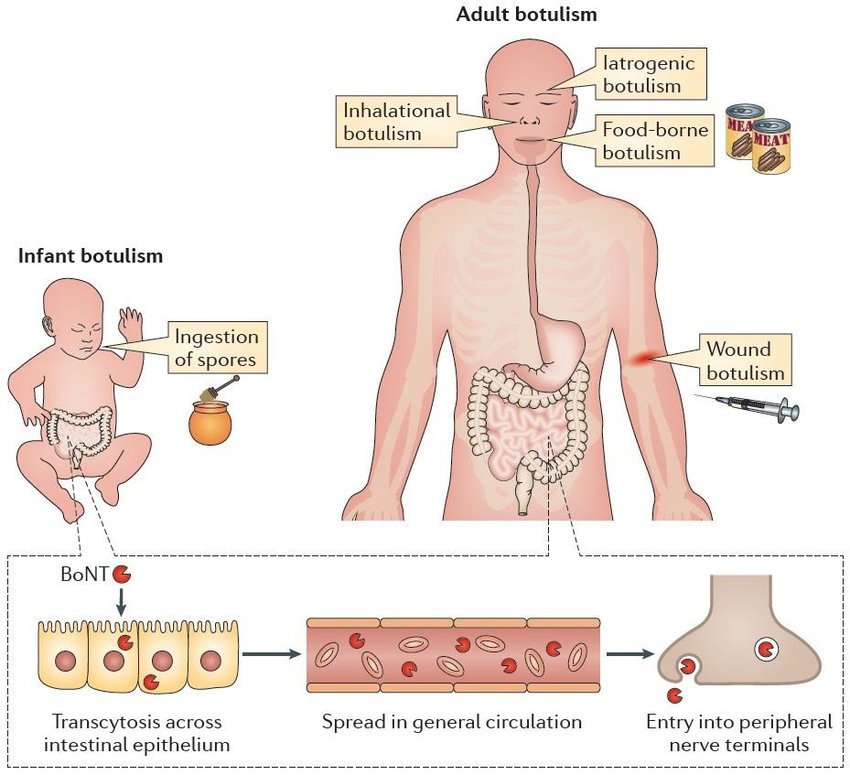 https://www.researchgate.net/profile/Cedric_Woudstra/publication/304792202/figure/fig2/AS:380429820547074@1467712945210/Human-form-of-botulism-Intoxination-due-consumption-of-food-contaminated- with.png