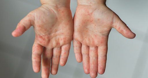 Wie Masern diagnostiziert werden Wie Masern diagnostiziert werden