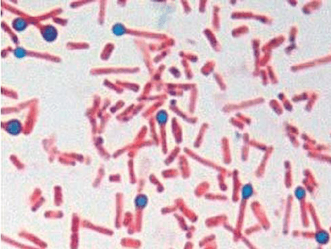 ein.  Sporen und Bakterien von Clostridium tetani mit einer typischen Trommelstockform, die in Fall 1 aus der Kruste der Enthornungswunden isoliert wurden (Gramm-Färbung-1000x). 