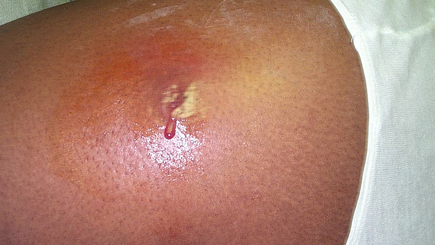 https://medde.org/wp-content/uploads/2020/12/hero-MRSA-infection-public-domain-image-PHIL.jpg
