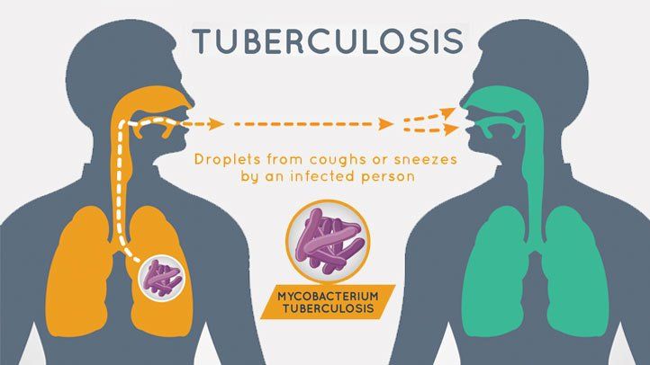 Tuberkulose: Ursachen, Symptome und Behandlung Tuberkulose: Ursachen, Symptome und Behandlung