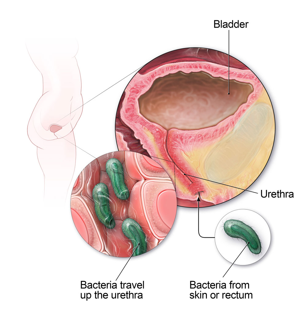 Bei Frauen können Bakterien aus der Haut oder dem Rektum die Harnröhre hinauf wandern und eine Blasenentzündung verursachen.