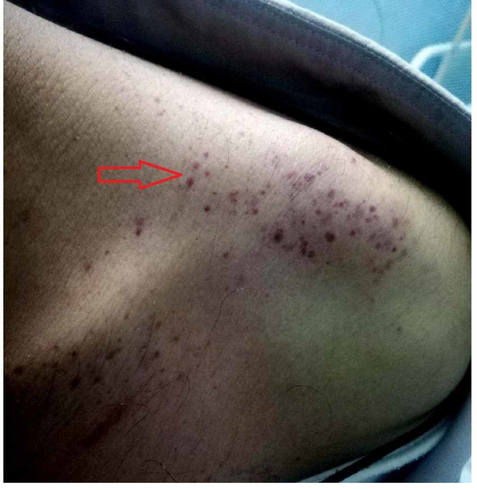 Multiple Purpura und Petechien auf der linken Schulter eines Dengue-Fieber-Patienten